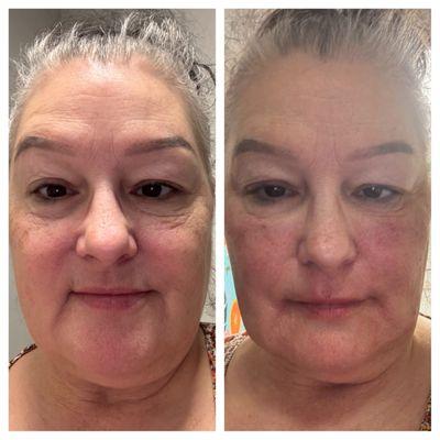 Before and immediately after