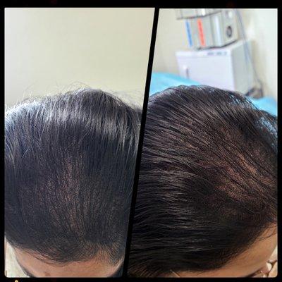 After 3rd Session Results!! The client loved the results! Scalp micropigmentation #1 Hair loss Solution!!