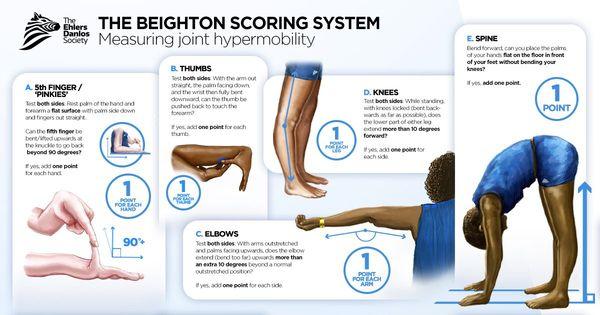 We use the Beighton Score to assess joint hypermobility and are committed to diagnosing EDS and connective tissue disorders.