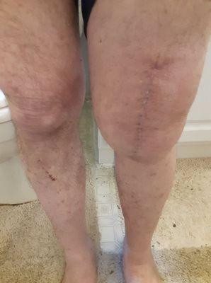 My 2nd failed knee replacements by Bates!!!