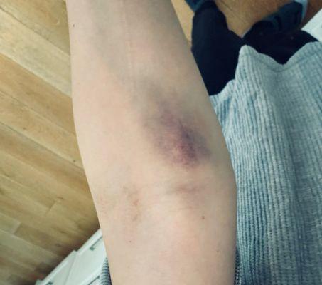 Look at what they did to my arm. After they injected me THREE TIMES in different arms I ran out of there as fast as I could.