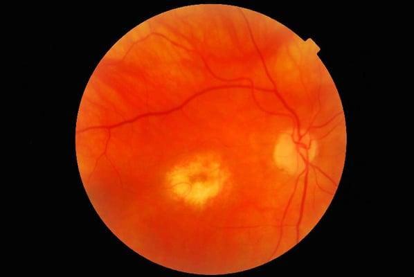 plaquenil macula damage