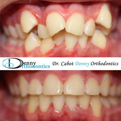 Severe crowding. Before and After