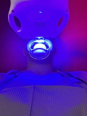 Teeth whitening!!!