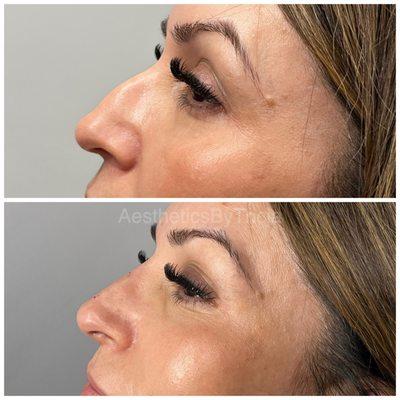 Nose filler
