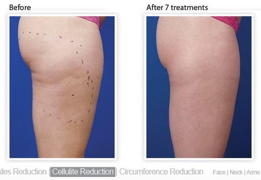 Cellulite reduction. Skin firming. Non-surgical lipo reduction . Fat melting. Fat burning treatments.