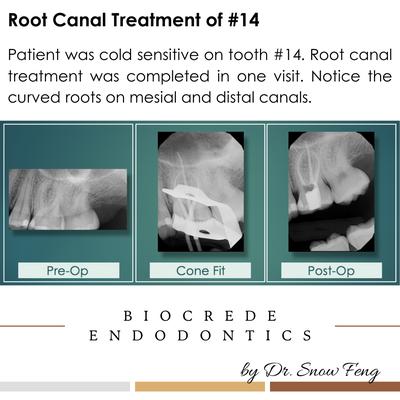 Patient was cold sensitive on tooth 14. Root canal treatment was completed in one visit. Notice the curved roots on mesial and distal canals