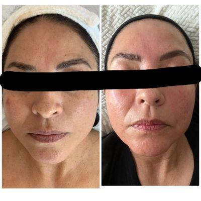 Before and after 3 signature treatments