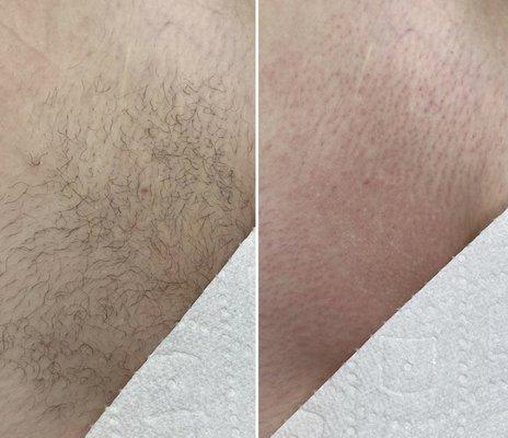 Brazilian Wax Before & After