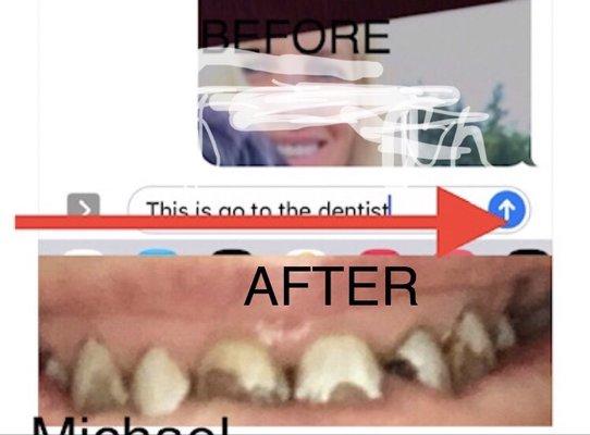 My natural teeth were intact he held me down and drilled them