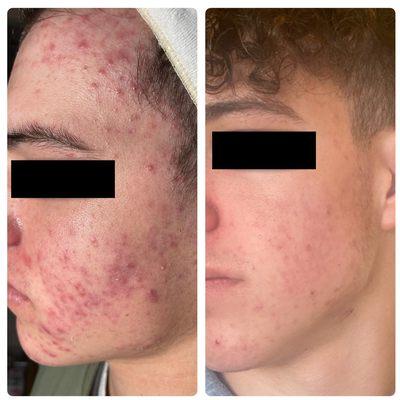 Teen Acne Before and After Acne Boot Camp