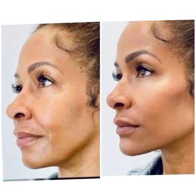 Facial balancing with sculpture and dermal filler.