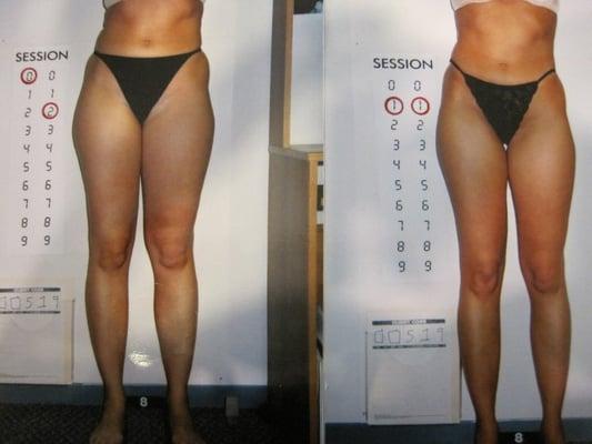 ENDERMOLOGIE: Before & After