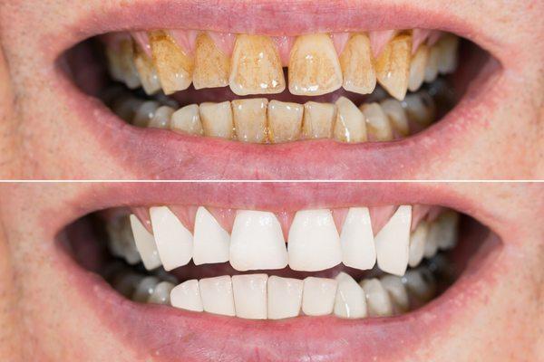 before and after teeth whitening