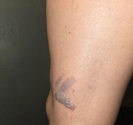 Second degree burn right after treatment