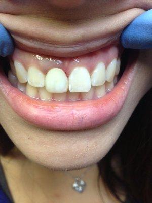 AFTER PREPARATION: immediately after preparing for temporary crown. Esthetic,layered and minimal bleeding