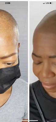 Alopecia and hair thinning treatment right here in Albuquerque, come and support out business.