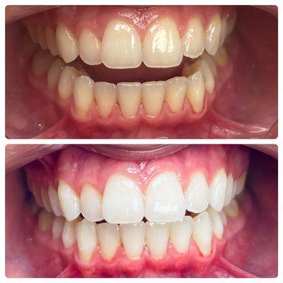 Teeth whitening with LED light.