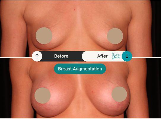 Before & After Breast Augmentation