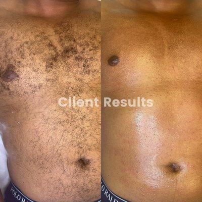 Male Chest sugaring results in Cheshire CT