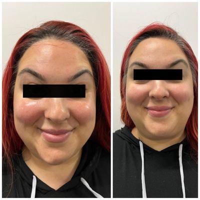 (Left) After hydrafacial with LED and microcurrent lift (Right) Before- Puffy, no contour or jawline