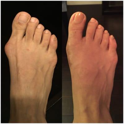 Before and after. 2 months post op.