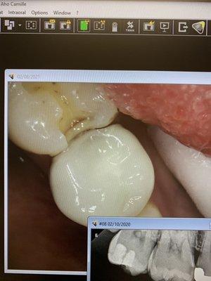 Cavity under the enamel(that grey disgusting line eww) seeing this really helps carry on good hygiene.