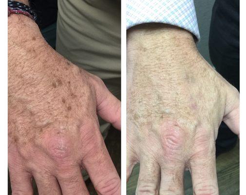 Before & After of an IPL treatment on the hand