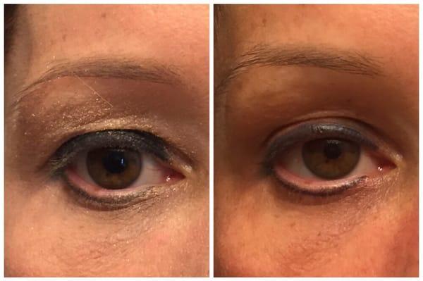 Upper eyelid lift with Botox Cosmetic alone.