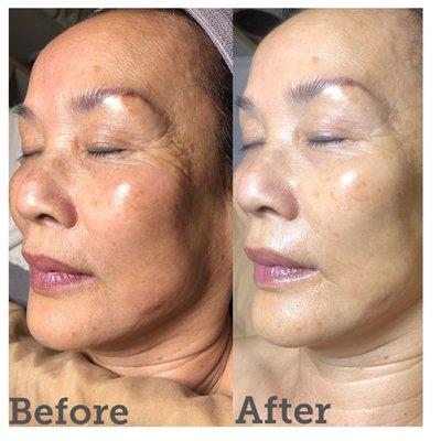 24k Facial with Microdermabrasion and Microcurrent