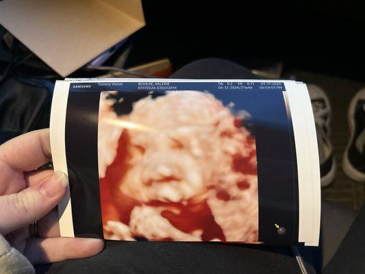 Tummy Vision 3D/4D Ultrasound & Gender Reveal