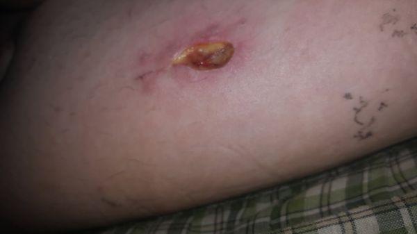 This is the results of this doctors stitching job. I am filing a complaint with the state medical board.