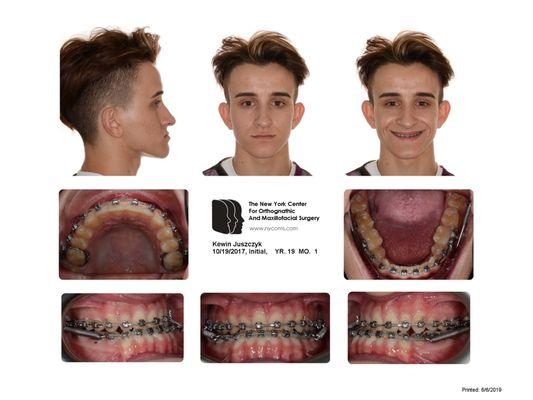 During treatment prior to surgery