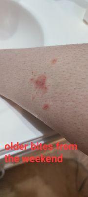 Bed bug bites I received while staying at the motel.