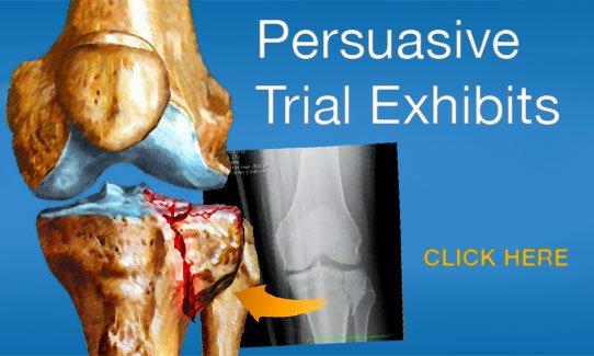 Personal Injury Exhibits