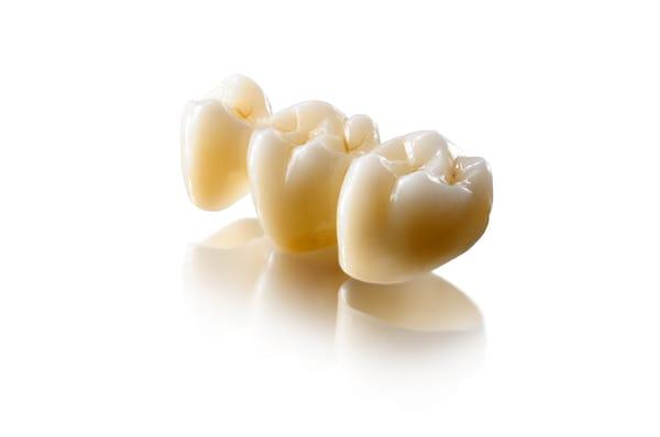 Example of our Zirconia Bridge!