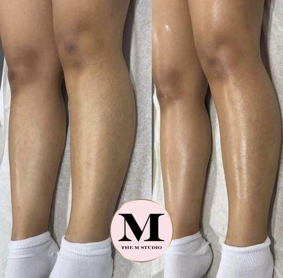 4 week hair growth after first wax and full leg wax results