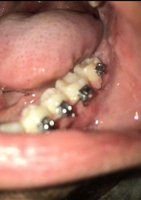 pain on my gums from braces