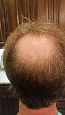 Before his hair piece was made and installed.