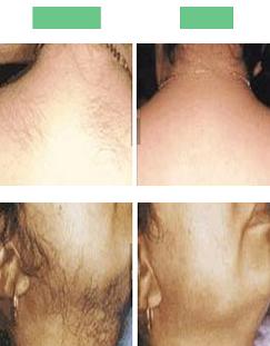 Laser Hair Removal | New York City