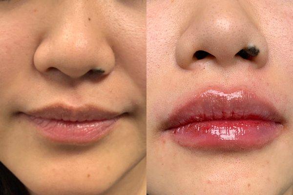 Lip enhancement treatment with 1 syringe of Restylane Kysse.