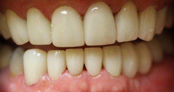 One of many reconstructed smiles, done by Dr.Klein.