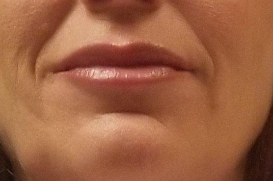 Lips one day post Kysse Restylane injections.