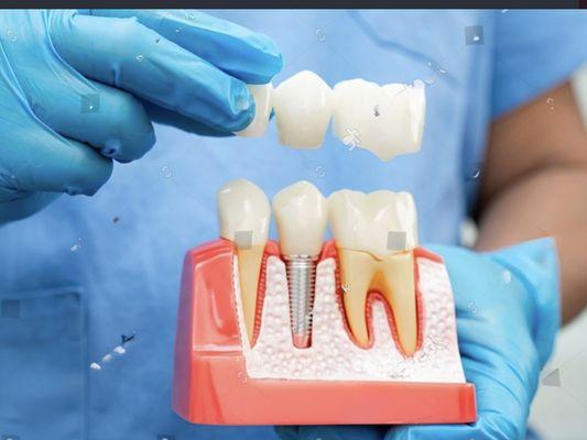 Implants that can last a lifetime!