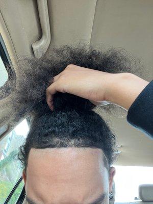 My hair line was way farther than my scar. You can literally see my hair that was originally there.