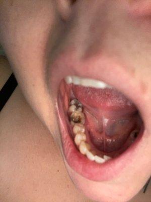 A hole in a unfinished root canal