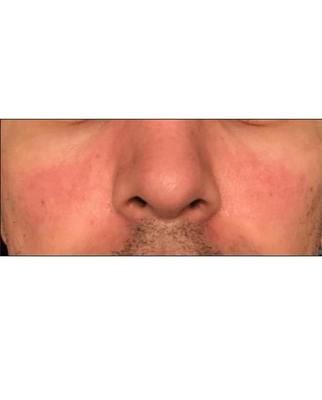 Malar rash caused by topical corticosteroid use prescribed by Alpine Dermatology