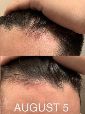 August 5 - The areas that were healed, were red and began to itch again.