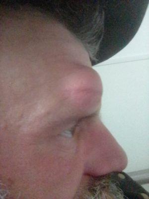 Lipoma removal my primary care physician will send you a referral for the removal for this!.