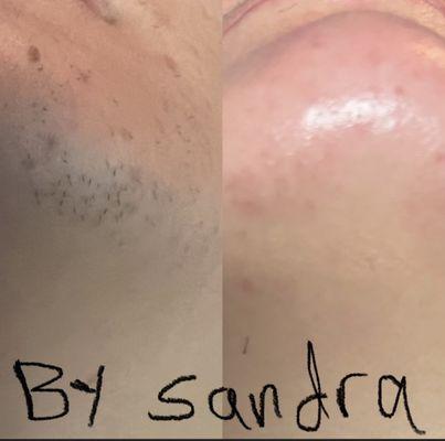 Thermolysis done by Sandra. PCOS chin